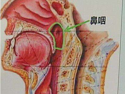 鼻咽癌的临床症状表现有哪些?